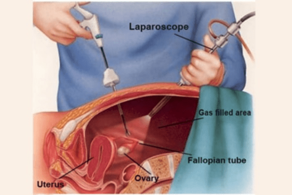 Laparoscopic Tubal Recanalization Surgery