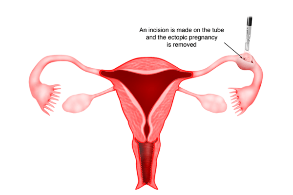 ectopic pregnancy