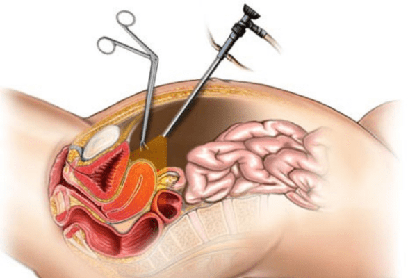 Laparoscopic surgery for uterine anomalies