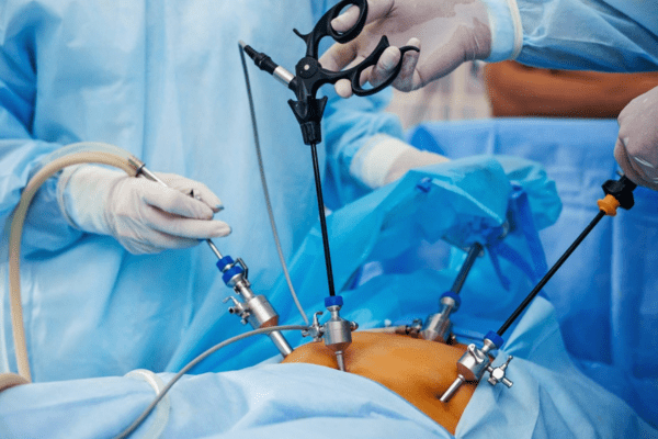 Uterus removal surgery