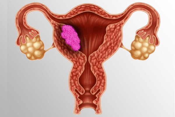 Uterine Cancer Treatment in Pune