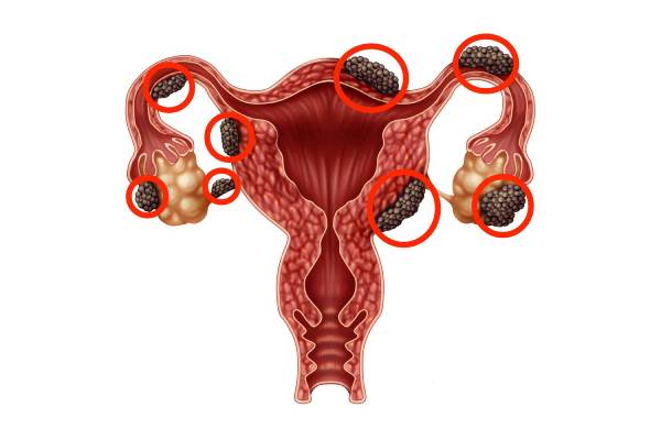 Laparoscopic surgery for endometriosis
