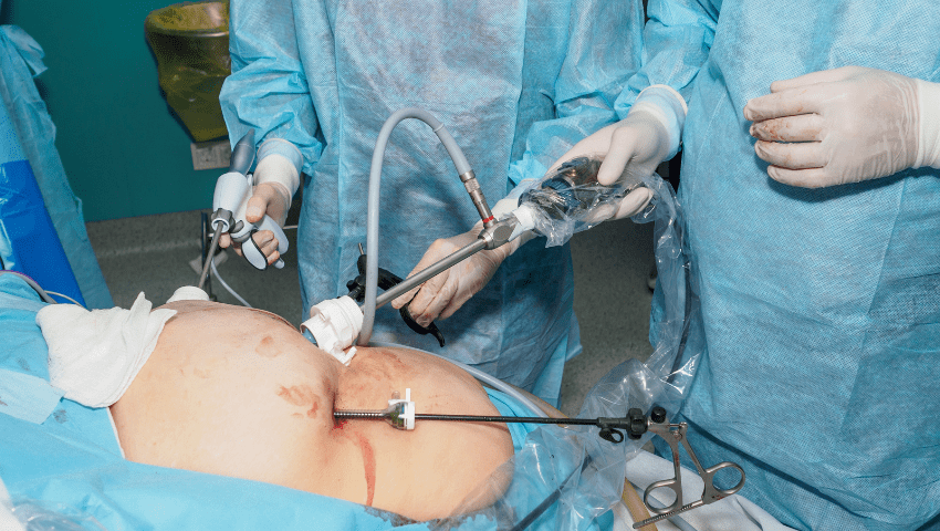 Laparoscopic Surgery in Gynaecology
