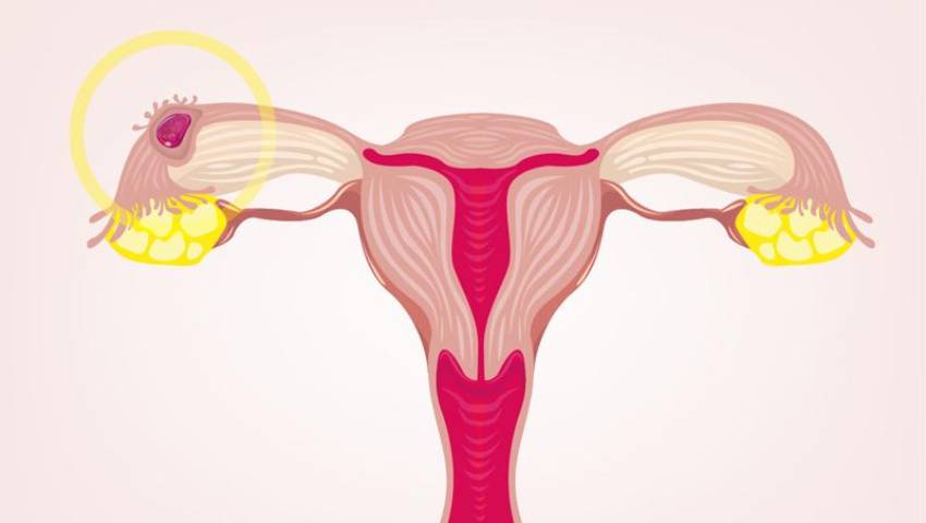 Ectopic Pregnancy