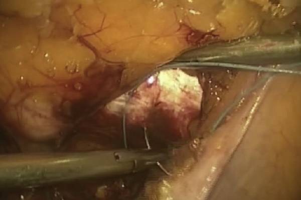 Lap Burch Colposuspension