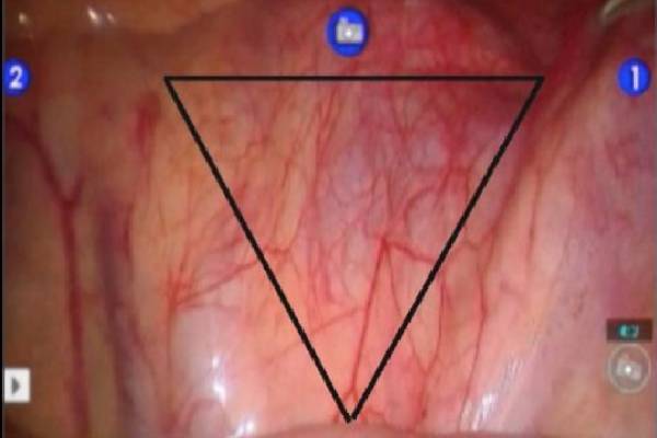 Lap Presacral Neurectomy