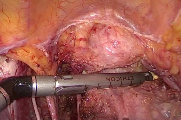 Lap Radical Hysterectomy