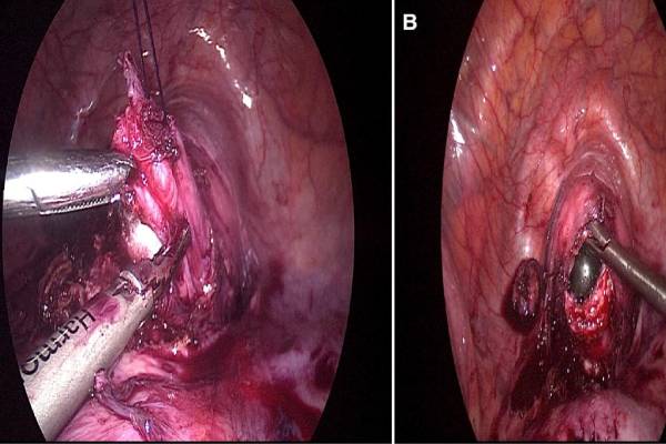 Lap Uterovaginal anastomosis for cervical agenesis