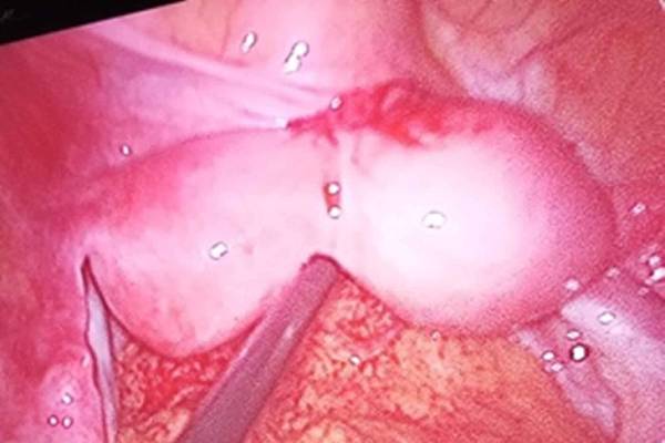 Lap excision of rudimentary horn