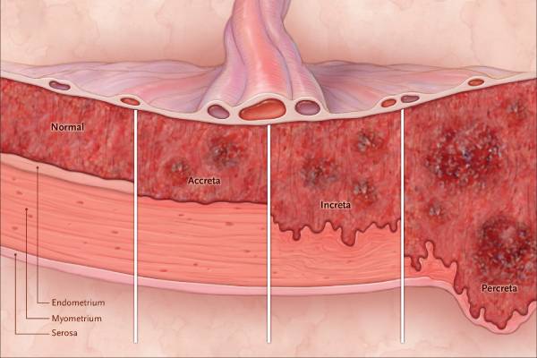 Placenta Accreta Spectrum