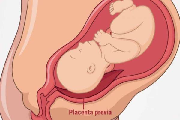 Placenta Previa