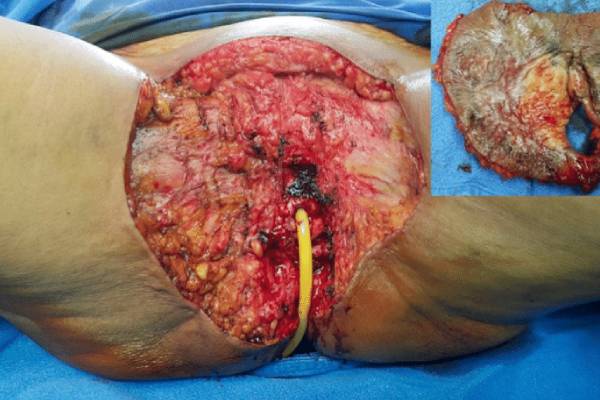 Radical Vulvectomy with VEIL for Ca Vulva