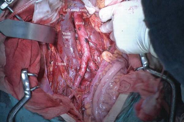 Staging Laparoscopy for Ca endometrium and Ca Ovary