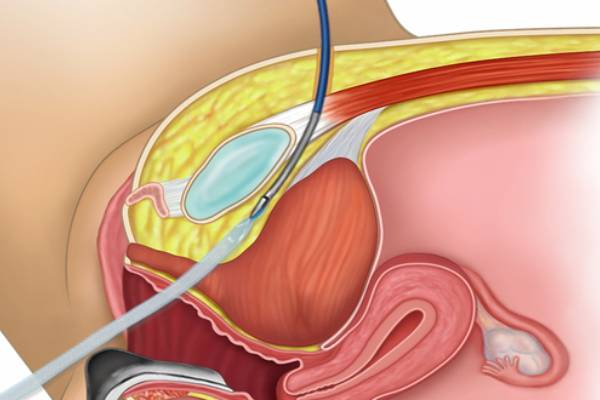 TOT for Stress Urinary Incontinence